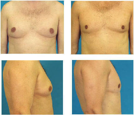 Gynecomastie avant apres