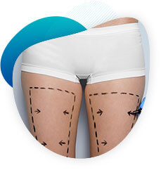 Lifting des cuisses